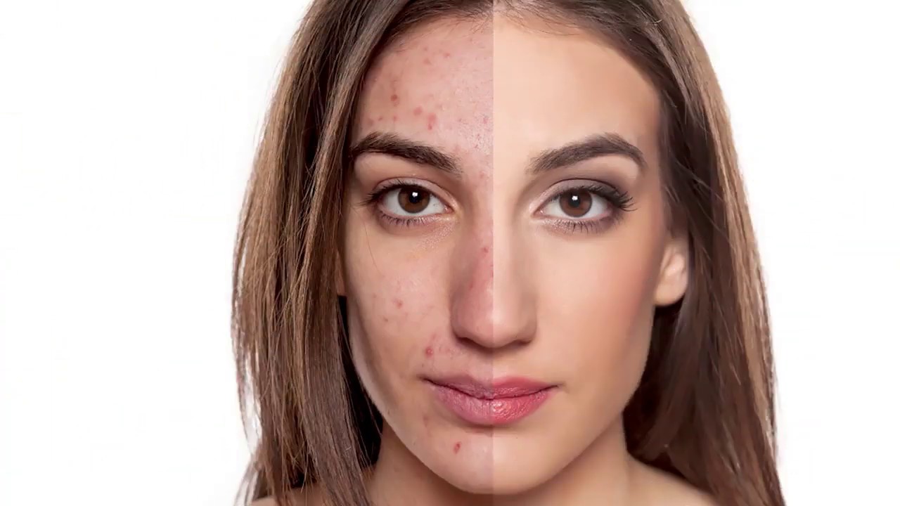 BREYLEE Acne Treatment Serum Face Facial Essence Anti Acne Scar Removal Cream Skin Care Whitening