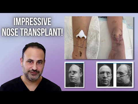 Video thumbnail: The Art and Science of Nose Transplant | Lesson of the Day · Beverly Hills Center for Plastic Surgery: Dr. Ben Talei
