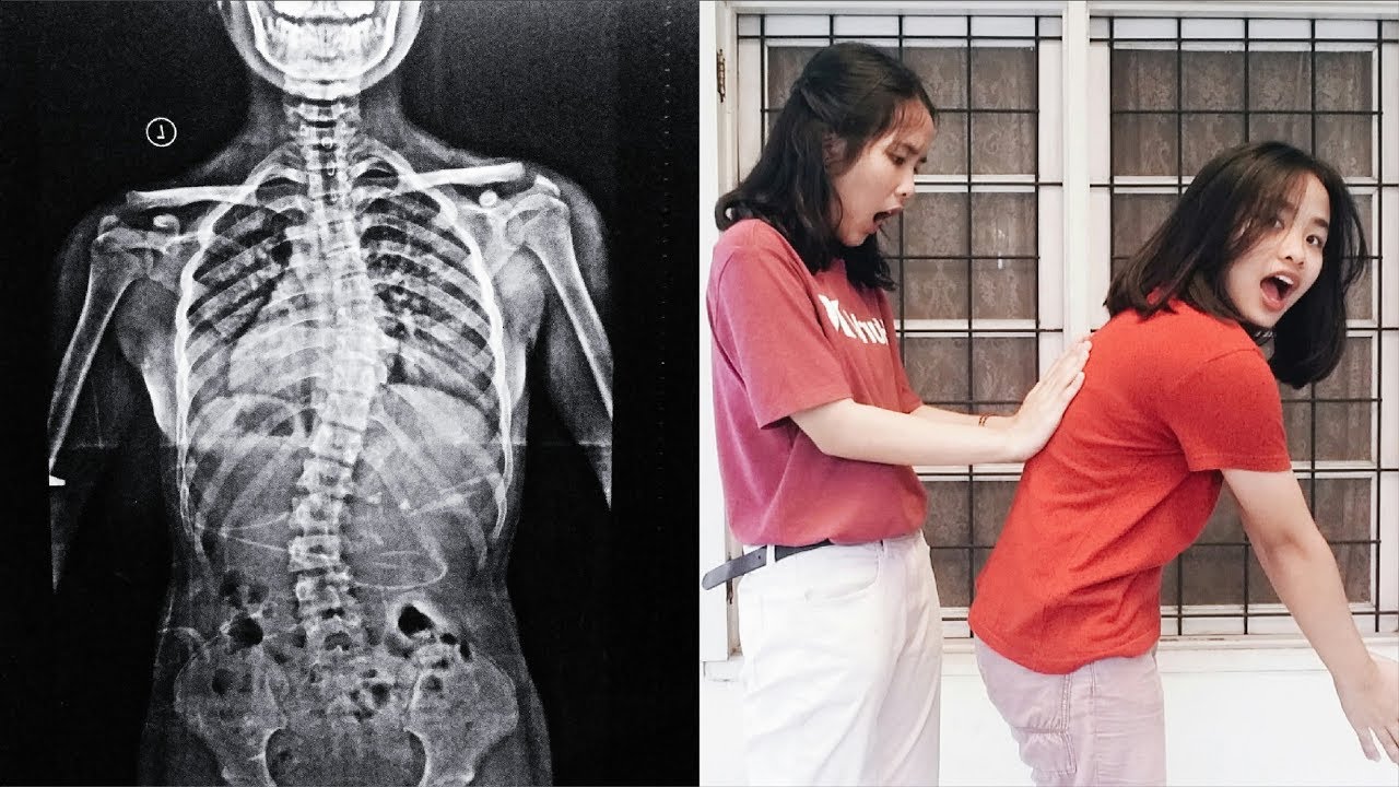 Aku Skoliosis Part 3 - Cara Mengetahui Apakah Kamu Skoliosis | Coorly