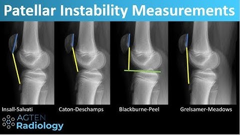 Patellar Instability - What and How to Measure