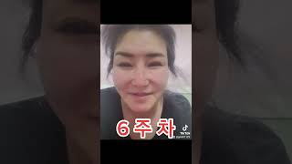 주름제거 리프팅 실험 6주차  성형 안하고 스포츠 테이핑으로 10년 되돌리기