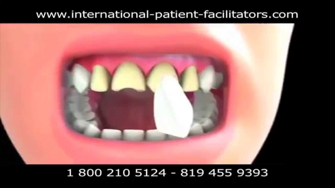 Veneers Cancun Mexico YouTube