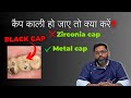 दाँतों की कैप काली हो जाए तो क्या करें?| What to do if Dental cap turns black? #AskDentist