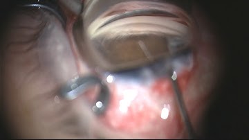 Bac Nguyen, MD: Kahook Dual Blade® (KDB) Prior Tube Shunt Case