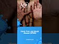 Hand, Foot, and Mouth Disease (HFMD) I Did you know?