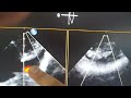 Left Subclavian Artery in TEE
