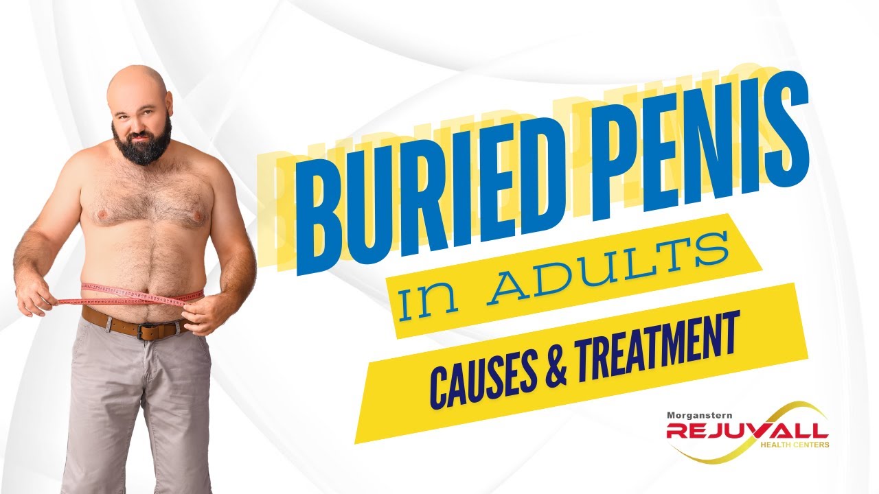 Buried Penis in Adults: Causes & Treatment