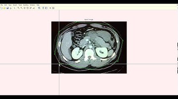 Medical Image Segmentation by Combining Graph