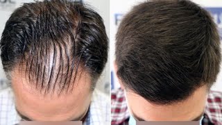 FUE Hair Transplant (3038 Grafts NW III Vertex) By Dr Juan Couto - FUEXPERT CLINIC, Madrid, Spain