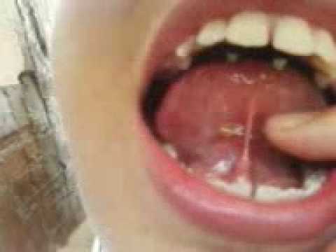 Que pasa si se te corta el frenillo de la lengua