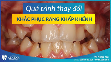Niềng răng mắc cài kim loại - khắc phục răng khấp khểnh | Nha khoa quốc tế Athena