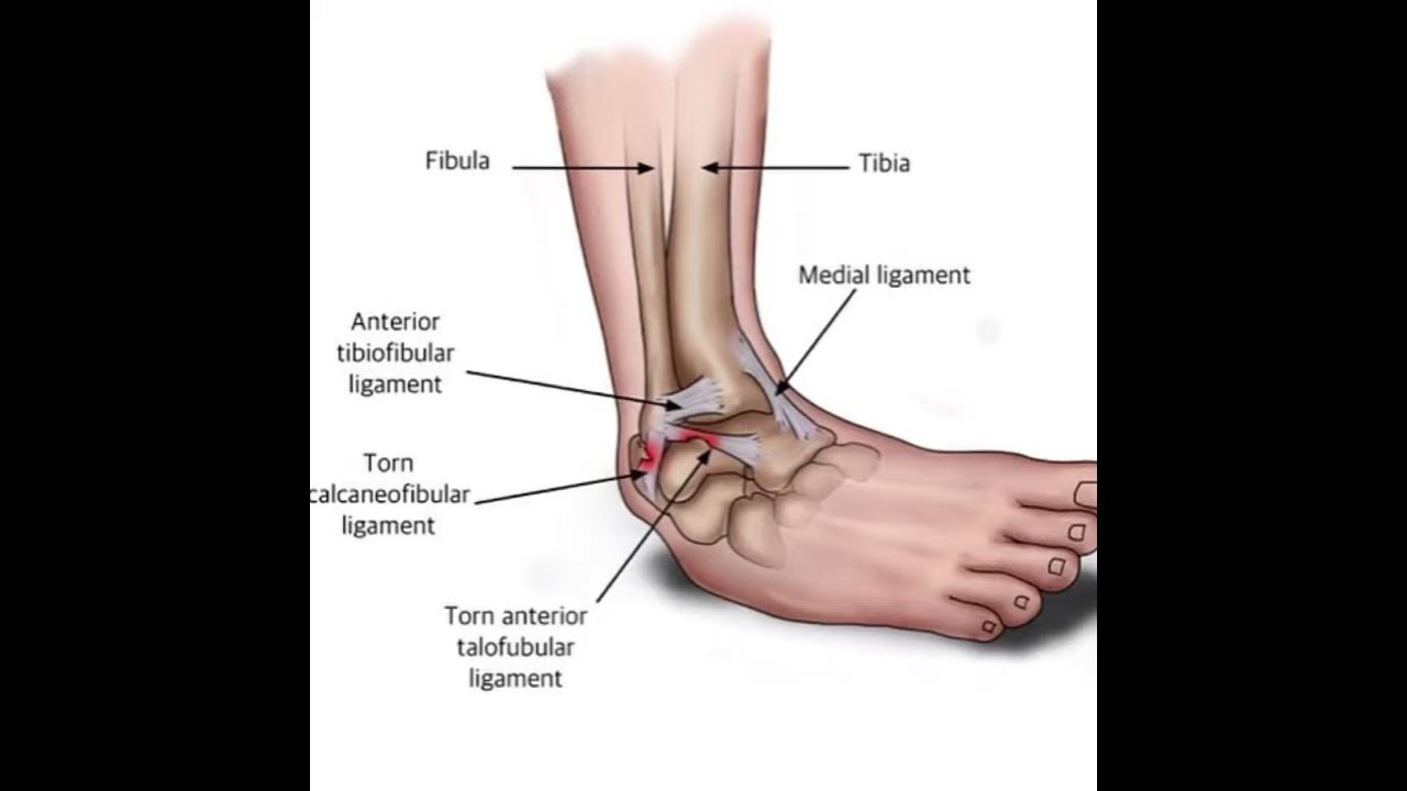 Неполный разрыв связок голеностопного сустава
