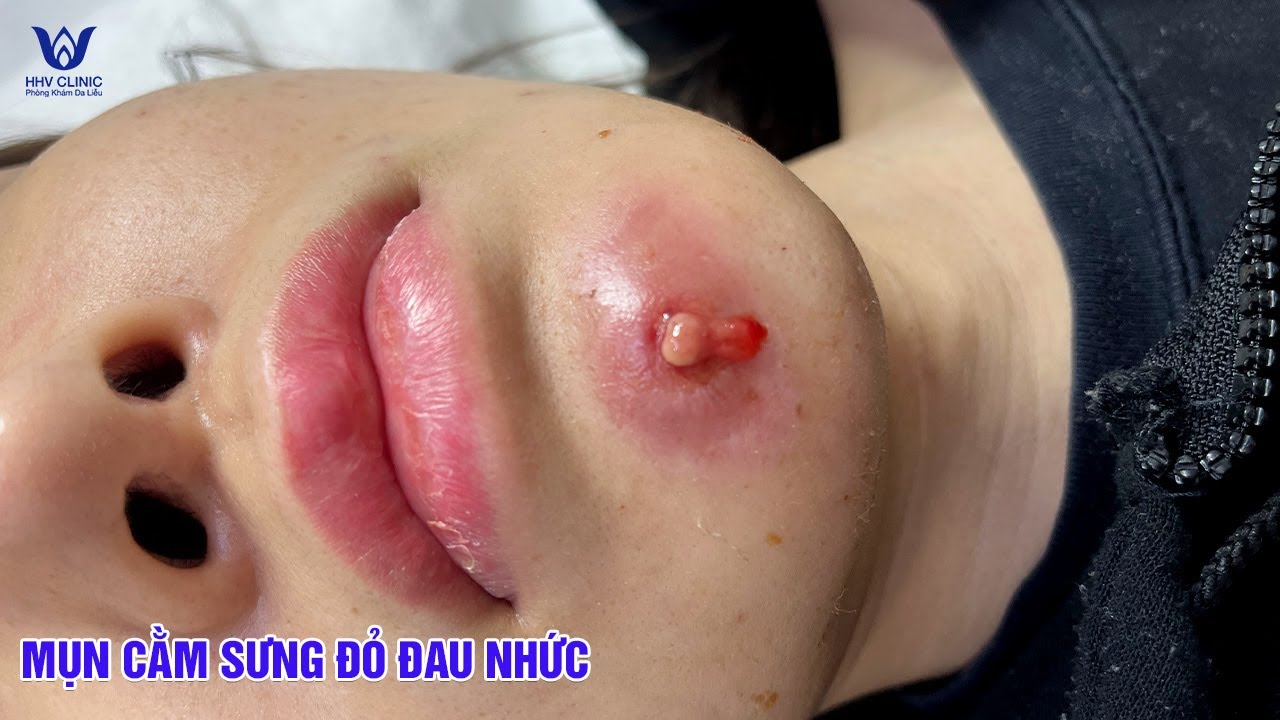 Mụn nhọt cằm sưng to, có nhân mủ trồi ra xử lý đúng cách - Không để lại sẹo.