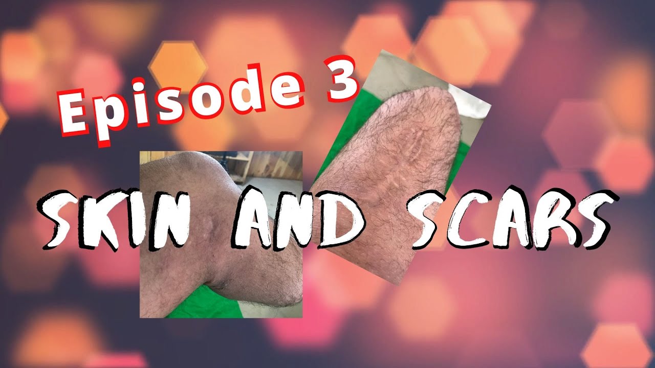 Episode 3 The Average Amputee Skin And Scars Yo