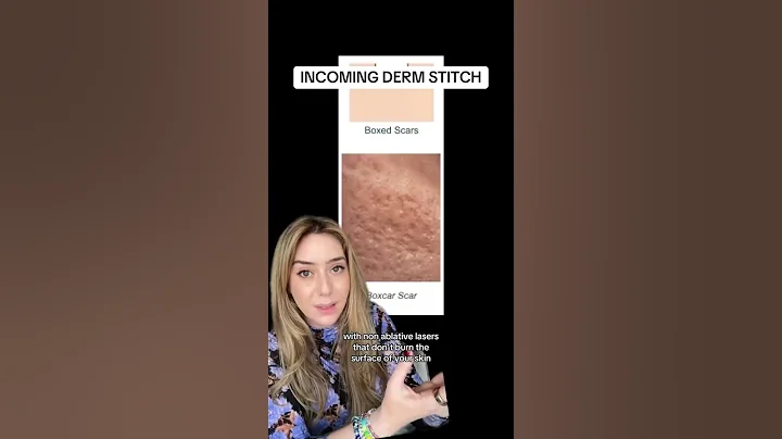 Treating Acne Scars Part 2 #shorts