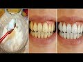 Com apenas uma aplicação elimina todos TARTARO dos DENTES e Clareia