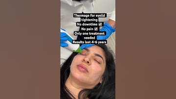 EYELID TIGHTENING #thermage #over40 #antiaging
