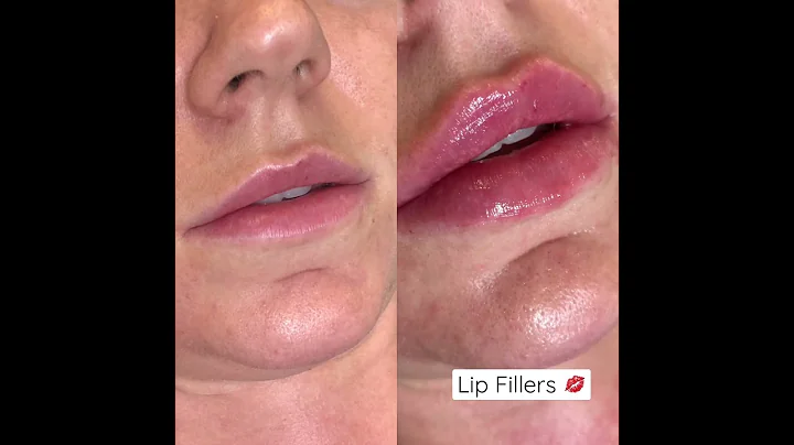Lip Filler
