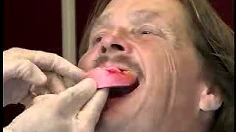 Complete Denture Procedure ; 15 Plane of Occlusion