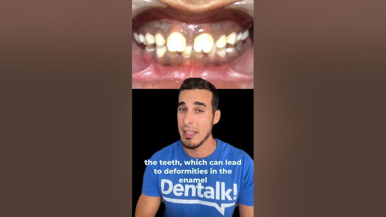 😲Incredible DENTAL MALFORMATION due to SYPHILIS MULBERRY molars and