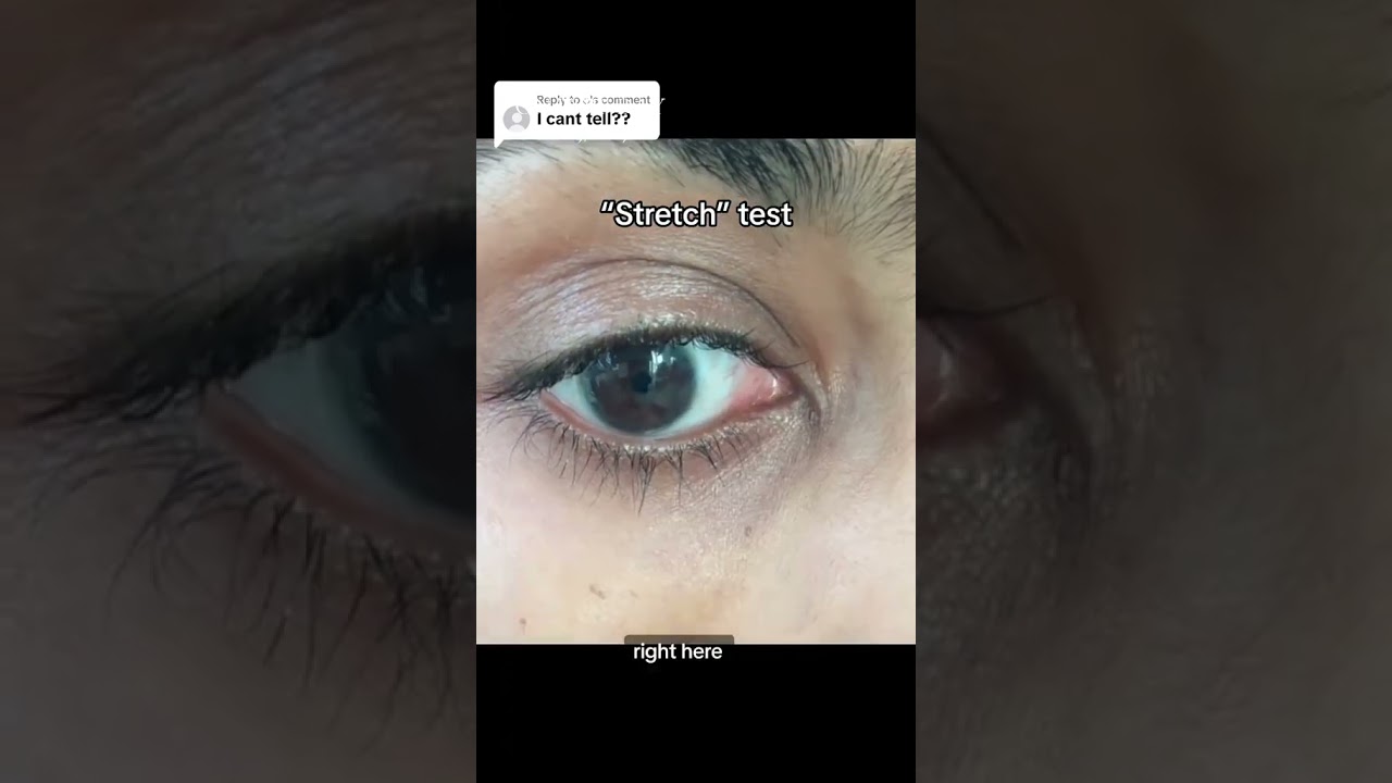 Dark circles “stretch test” from a dermatologist 