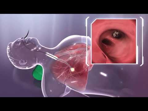 Vidéo: Comment se forme le liquide pleural ?