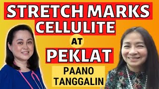 Stretch Marks, Cellulite at Peklat: Paano Tanggalin - By Doc Katty Go and Doc Liza Ong