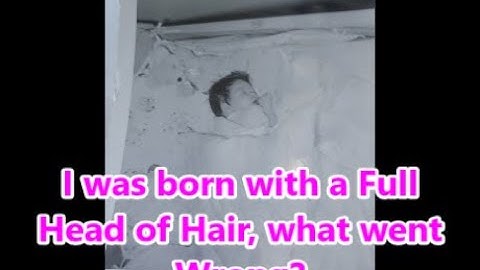 My Hair loss Chronicles   |   Photo Diary (Yikes !!)   |   Alopecia Awareness Month
