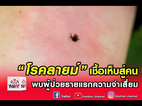 ข่าวไทยไทย | “โรคลายม์” เชื้อเห็บสู่คน พบผู้ป่วยรายแรกความจำเสื่ยม 17/07/62