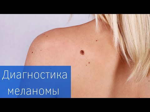 Меланома: ранняя диагностика!