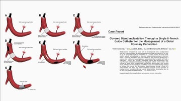 How to Approach Coronary Stent Loss - Emmanouil S. Brilakis, MD, PhD