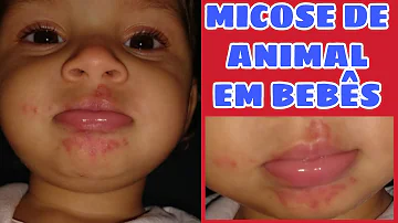 Qual pomada usar para micose em bebê?