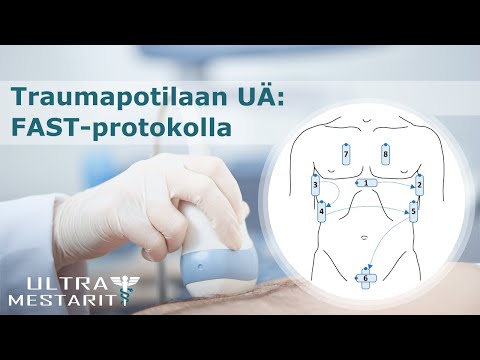 Video: Perikardiaalinen Effuusio Tamponadilla: Sängyn Ultraäänitutkimus Pelastaa Toisen Hengen