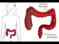 ¿Cómo eliminar la colitis? / Remedios para la colitis