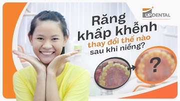 Răng khấp khểnh thay đổi như thế nào sau khi niềng răng?