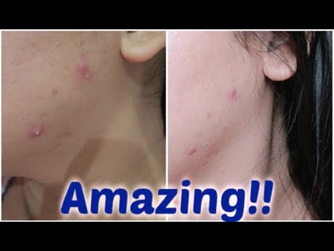FLATTEN PIMPLES OVERNIGHT!! ACNE CARE DRYING LOTION REVIEW