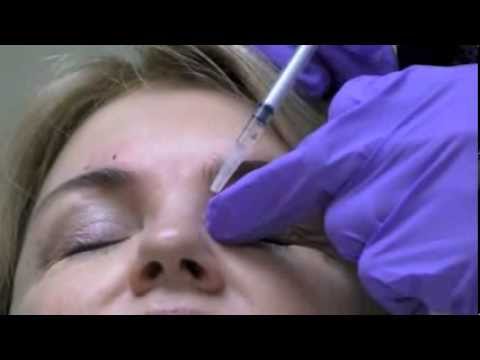 Botox Glabella and Bunny Lines - YouTube