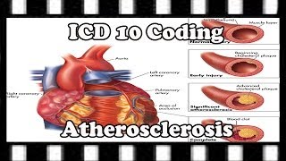 ICD-10 Coding Tutorial: How to Code Atherosclerosis screenshot 2