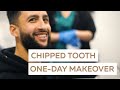 Chipped Tooth One-Day Smile Makeover | Nate's Story