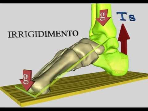 Video: Che cos'è una fusione dell'articolazione sottoastragalica?