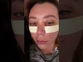 Lower Blepharoplasty Recovery Progress, Under Eye Bag Removal by Dr. Taban