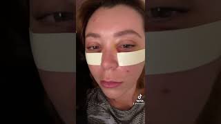 Lower Blepharoplasty Recovery Progress, Under Eye Bag Removal by Dr. Taban