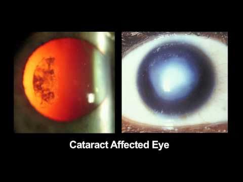 CATRA: Cataract Maps with Snap-on Eyepiece for Mobile Phones