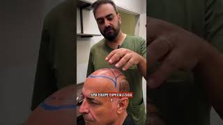 FB Clínica l TRANSPLANTE CAPILAR
