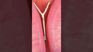 How To Prevent Pregnancy With Iud Insertion?