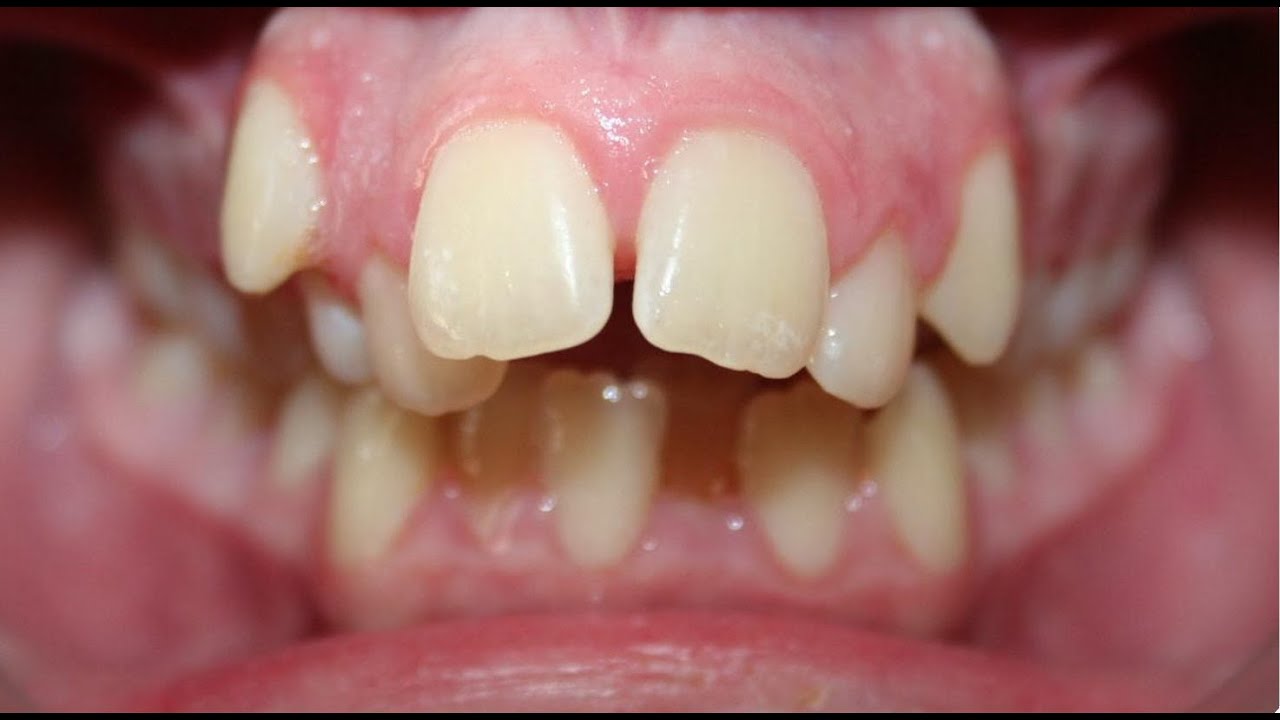 When Orthodontic Orthotropics Treatment is Needed for my child 2 YouTube