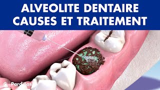 ALVÉOLITE DENTAIRE - Infection après extraction dentaire: causes et traitement ©