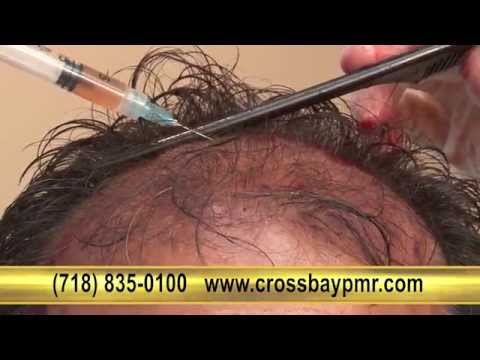 Caudal epidural steroid injection video