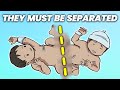 What Happens When Conjoined Twins Must Be Separated