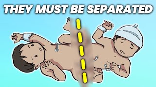 What Happens When Conjoined Twins Must Be Separated